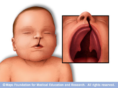Complete unilateral cleft lip and palate.